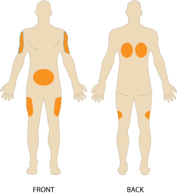 Volume of Injection to be administered by Parenteral route: IV, IM, SC ...